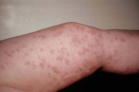 Allergic Vasculitis Rash