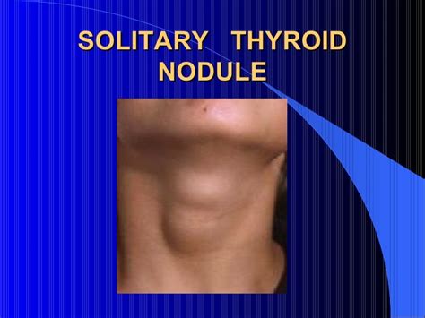 Solitary Thyroid Nodule