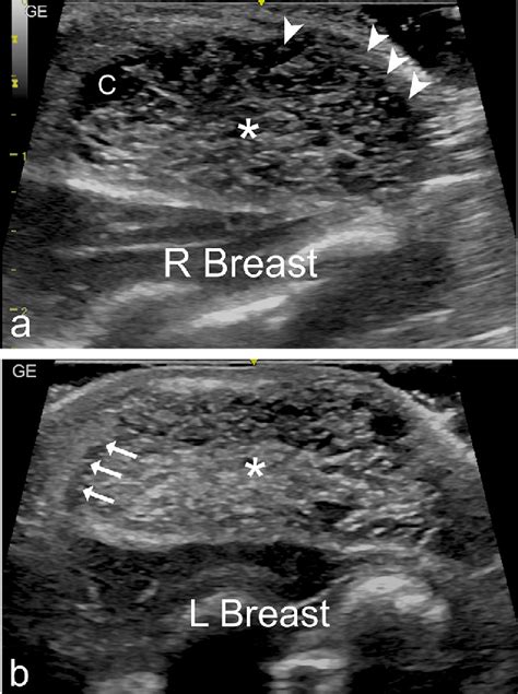 Figure 3 From Role Of Ultrasound In Diagnosis Of Neonatal Breast
