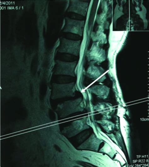 Mri Sagittal View Of Lumbosacral Spine Shows L3 4 Spondylolisthesis