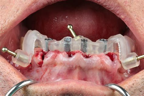 Tips In Guided Dental Implant Placement Iti Blog
