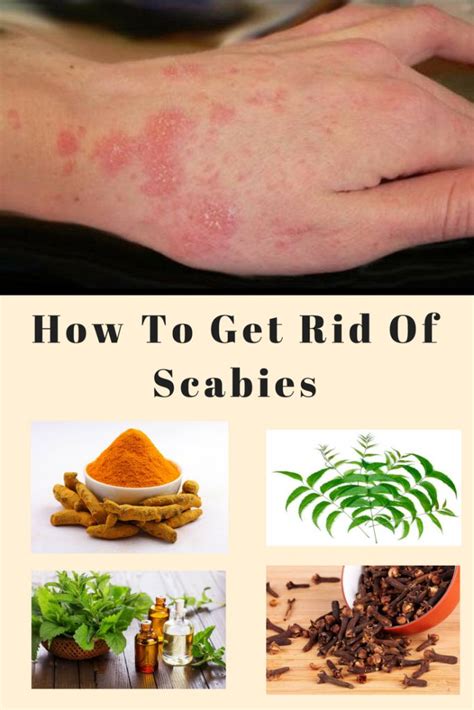 What Is The Most Effective Treatment For Scabies