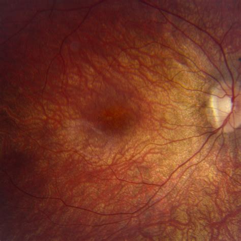 Lebers Hereditary Optic Neuropathy Doheny Eye Institute