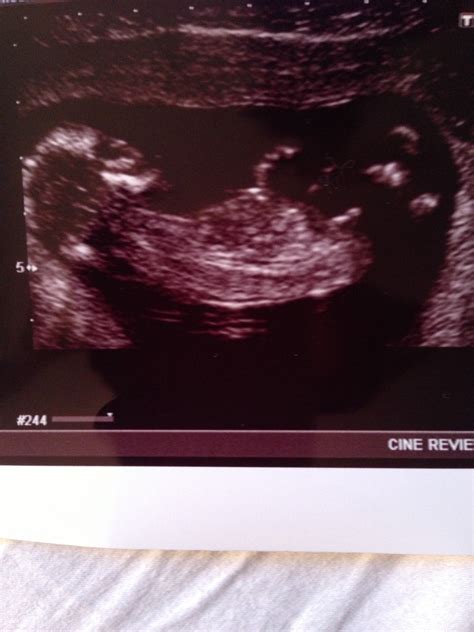 12 Week Ultrasound Pictures Any Gender Guesses
