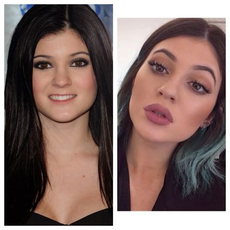 kylie jenner plastic surgery before and after pictures women in the world