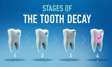 Tooth Decay Stages Dental Dentist