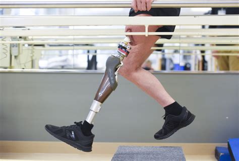 Osseointegration Surgery Gives Amputee Hope For Better Faster And
