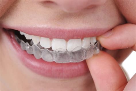 Cost factors when getting dentures. How Much Does Dental Braces Typically Cost in Singapore ...