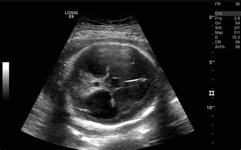 Soft Antenatal Markers On Ultrasound Pacs