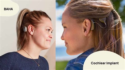 Bone Anchored Hearing Aids Baha Vs Cochlear Implants And Traditional