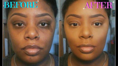 In this video, we see scar removal on nose a very simple painless scar removal procedure on nose by dr. How To: Color Correct/Conceal Dark Circles, Acne Scars ...