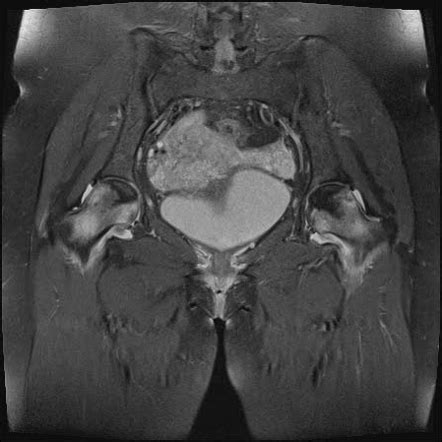 Avascular Necrosis Of Hip Mri Radiology Case Radiopaedia Org