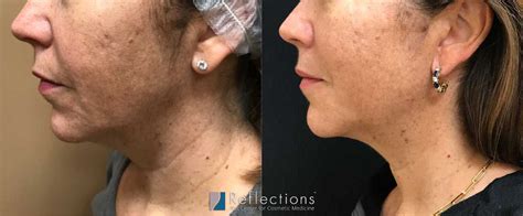 Non Surgical Facelift With Ulthera Sofwave Radiesse And Liquid