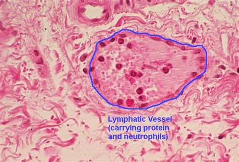 Basic Histology Lymphatic Channel In Inflammation