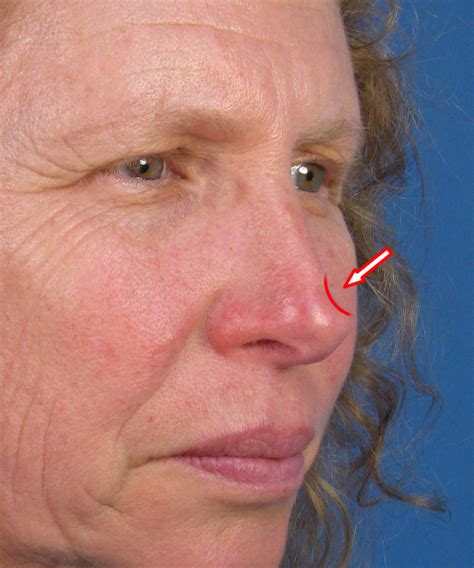 Skin Cancer On Your Nose Symptoms Idaman