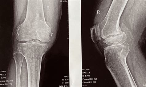 Cureus Non Union Of Isolated Medial Condyle Of Femur Hoffa Fracture