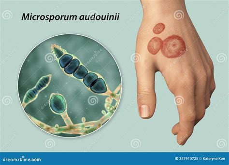 Hand Fungal Infection Tinea Manuum 3d Illustration Stock Illustration