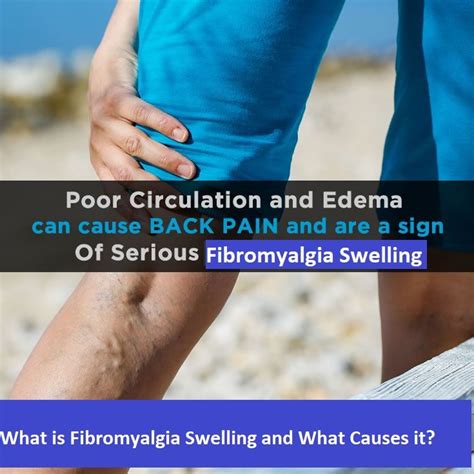 What Is Fibromyalgia Swelling And What Causes It What Is