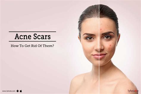 Acne Scars How To Get Rid Of Them By Dr Javaid Ahmad Bhat Lybrate