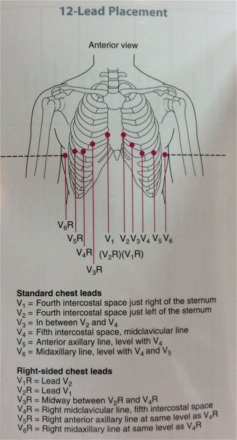 12 Lead Diagram For Both Left And Right Side Nclex