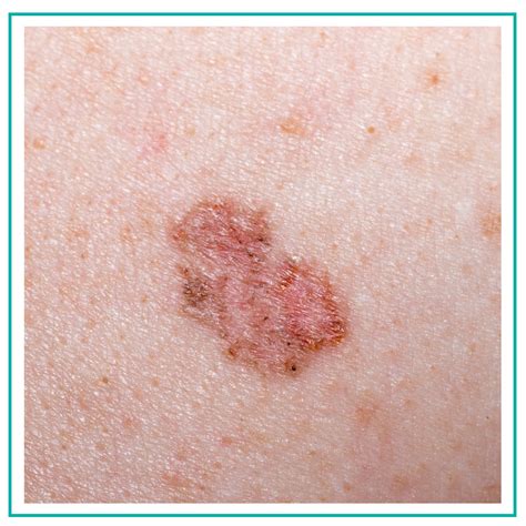 Cancer Types Types Of Basal Cell Carcinoma Skin Cance