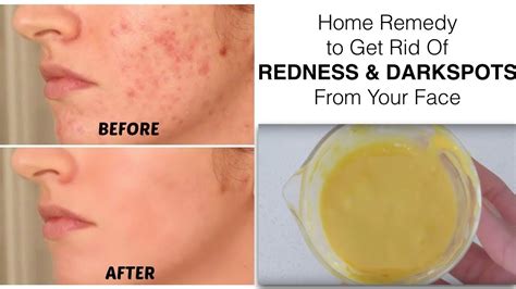 How To Get Rid Of Redness On Face From Acne