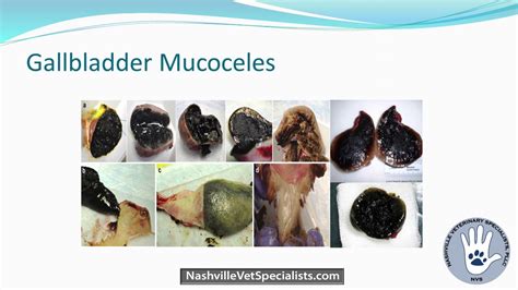 Gallbladder Mucoceles Medical And Surgical Perspectives Youtube