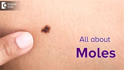 Know More About Skin MOLES What Causes MOLES On Your Body Dr Renuka Shetty Doctors