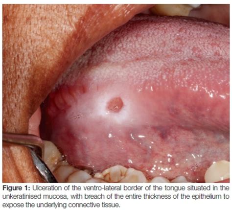 Oral Mucosal Ulceration A Clinician S Guide To Diagnosis And Treatment