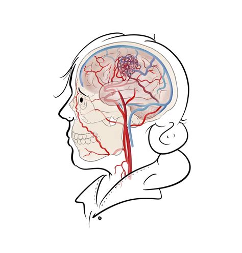 Artero Venous Malformation Avm Brainbook