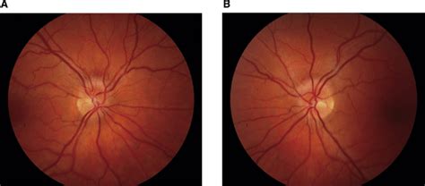 A Colour Fundus Photographs Demonstrating Optic Disc Edema In The