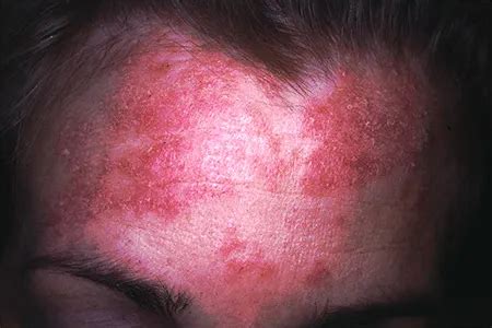 Seborrheic Dermatitis Pictures Causes Shampoo Treatment