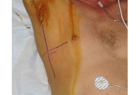 Anesthetize skin and deeper base of axilla. Best Practices: Tube Thoracostomy Insertion ~ NURSING ...