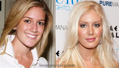 Total Transformation Of Heidi Montag Lovely Surgery