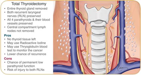 Minimally Invasive Thyroidectomy Larian Md