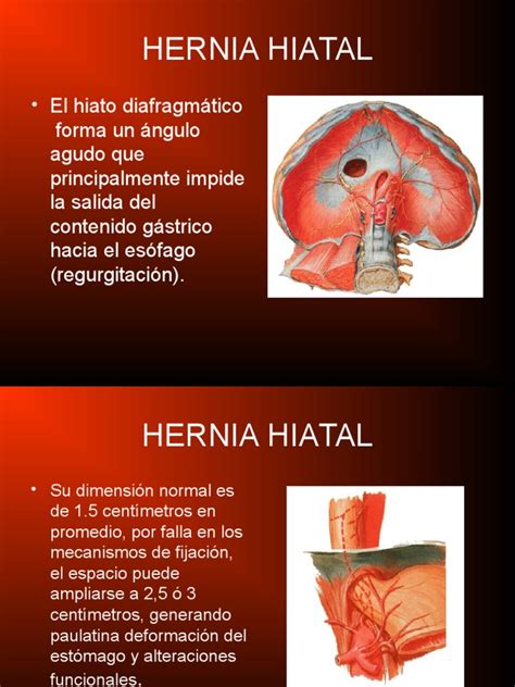 Hernia Hiatal La Enfermedad Por Reflujo Gastroesofágico