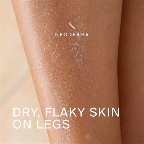 Dry Flaky Skin On Legs Neoderma