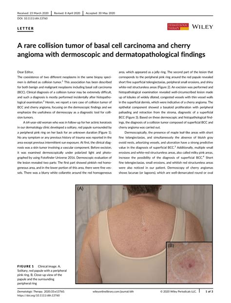 A Rare Collision Tumor Of Basal Cell Carcinoma And Cherry Angioma With