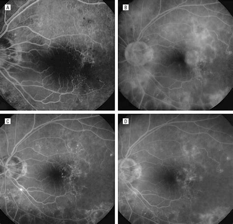Intravitreal Triamcinolone For Radiation Induced Macular Edema