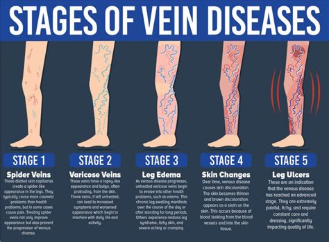 What Are Venous Stasis Ulcers Causes And Treatment