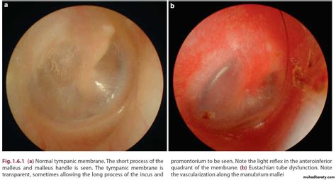 Disease Of Middle Ear Pptx د احمد محي Muhadharaty