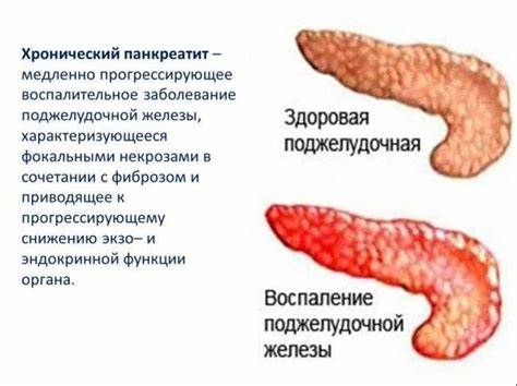 Воспаление геморроя диета