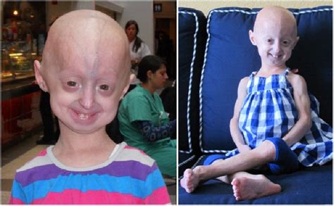 Hutchinson Gilford Progeria Syndrome Intechopen