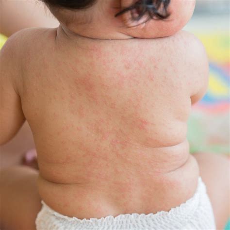 Roseola Childhood Disease Disease Symptoms Fifth Disease