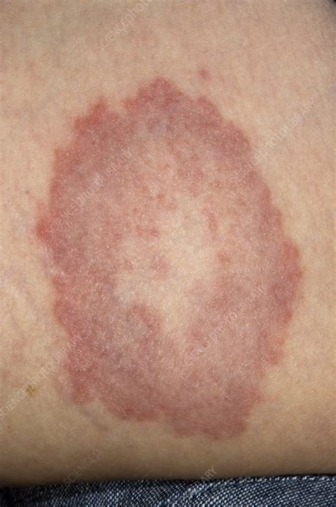 Granuloma Annulare On The Skin Stock Image C0029593 Science