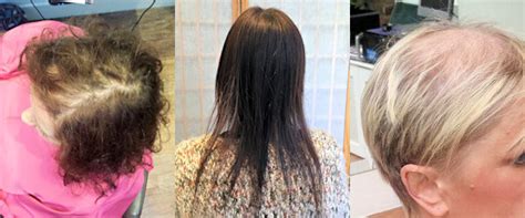 While many with pcos grow thicker hair on their face and body, some pcos experience hair loss and hair thinning. Hair Loss News and Thoughts - from Lucinda ElleryHair Loss ...