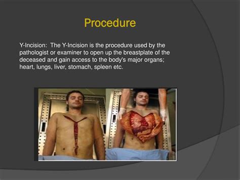 Ppt Autopsies Powerpoint Presentation Free Download Id1555682