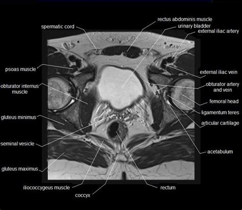 Muscles Of Pelvis Ct Anatomy