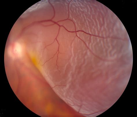 Retinal Detachment | Wills Eye Hospital