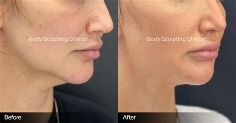 Before And After Body Sculpting Clinic